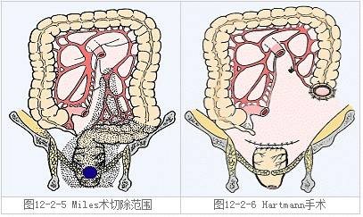 Miles手术