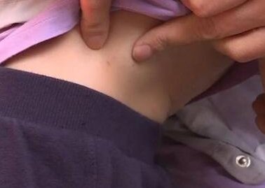 5岁男童遭狗扑咬整夜做噩梦,这种情况是否需要心理疏导?