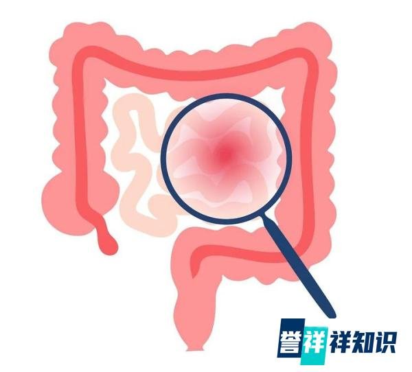 26岁妈妈从腹泻到肠癌仅仅1年!胃肠不舒服,再年轻也要做胃肠镜检查