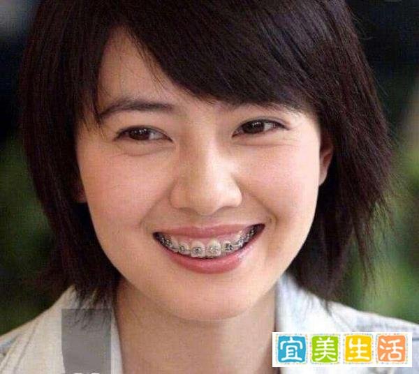 明星整牙堪比整容，高圆圆笑得好看全靠牙，蔡徐坤胡歌似变了个人