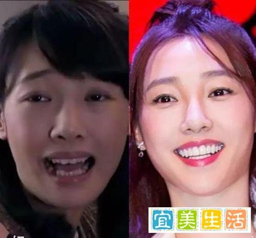 明星整牙堪比整容，高圆圆笑得好看全靠牙，蔡徐坤胡歌似变了个人