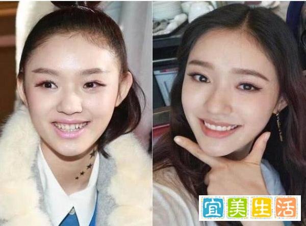 明星整牙堪比整容，高圆圆笑得好看全靠牙，蔡徐坤胡歌似变了个人