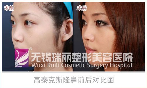 高泰克斯的高泰克斯隆鼻缺点