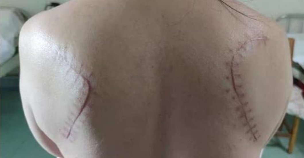 孝感一女子撞伤右肩被做左肩手术，这种医疗事故在医疗业常见吗？